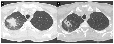 JoF Free Full Text Invasive Pulmonary Aspergillosis