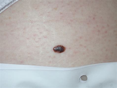 Nodular Melanoma