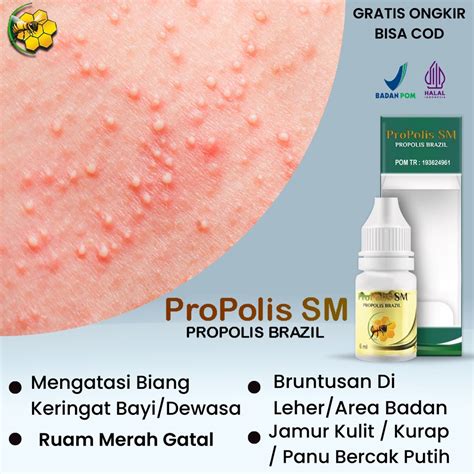 Jual Propolis Sm Obat Oles Biang Keringat Ruam Panas Ruam Merah