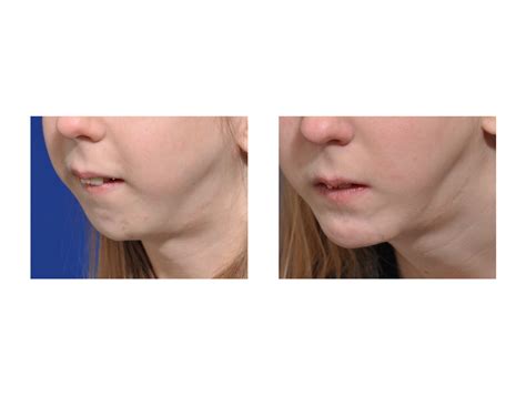 Plastic Surgery Case Study Jumping Genioplasty For Severe Chin Jaw