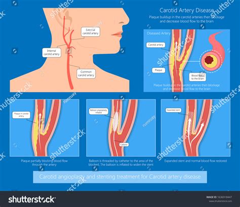 Coronary Artery Disease Cad Diagnosis Carotid Stock Vector (Royalty ...