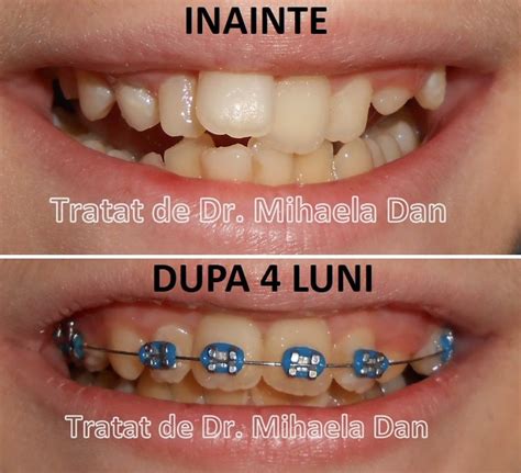 Cat Costa Un Aparat Dentar Orto Implant Expert Cat Platesc