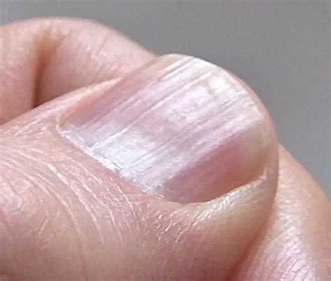 Unhas Estriadas Causas Sintomas Tratamento Top Dicas