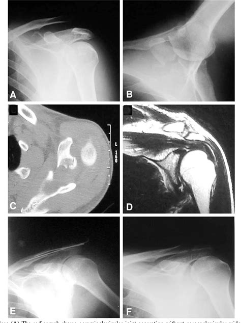 Figure 3 From Acromioclavicular Separation With The Fracture Of The Coracoid Process 2 Cases