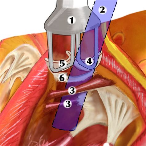 Ct Scan Image Of Aortic Root Abscess Figure 3 Aortic Root