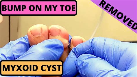 Bump On My Toe Digital Myxoid Cyst How To Remove Part Youtube