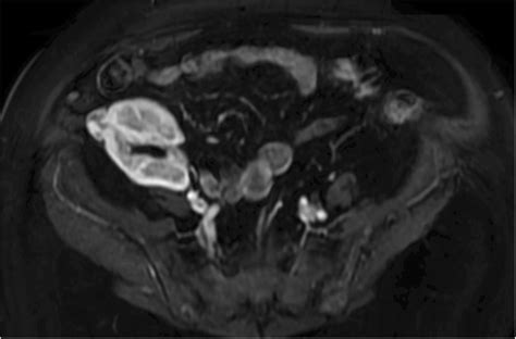 Magnetic resonance imaging (MRI) was used for the follow-up evaluation... | Download Scientific ...