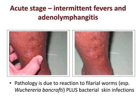 Don T Neglect The Ntds Ppt