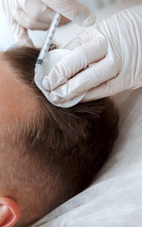 PRP For Hair Loss Treatment Revitalis