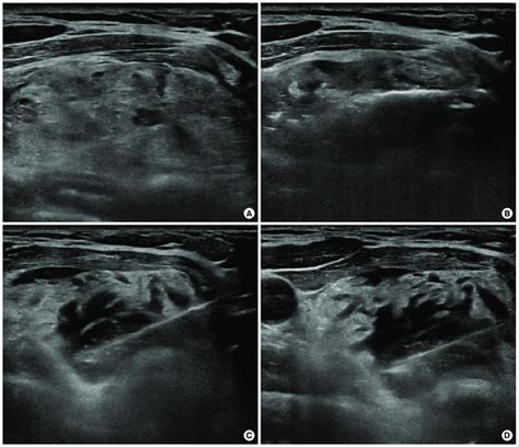 A Ultrasonography Showing A Benign Thyroid Nodule 1 7×3 8×4 5 Cm In