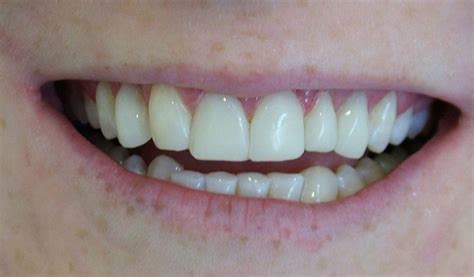 Tooth Bonding And Reshaping Adelaide Cosmetic Dentistry