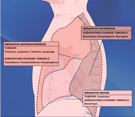 Respiration Incident V Nement Mispend Tumeur Cage Thoracique