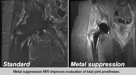 Bone Density Test Lateral Knee Pain UCSF Radiology