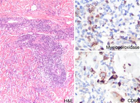 Histological Findings Include Perivascular And Interstitial Infiltrate