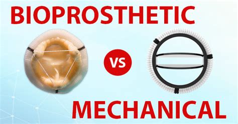 Surgeon Q&A: Bioprosthetic vs. Mechanical Valve Replacements