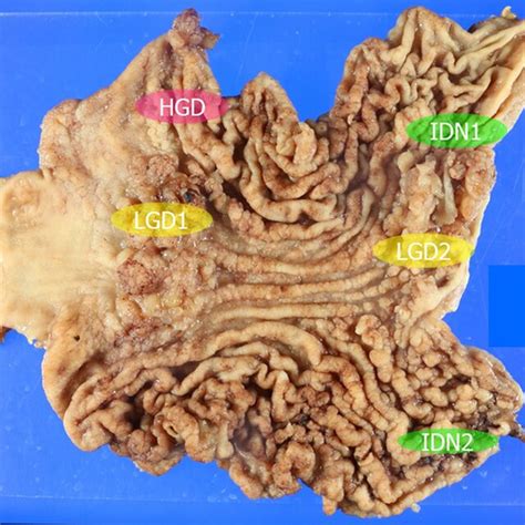 Gross Findings From The Resected Stomach Tissues Of Case