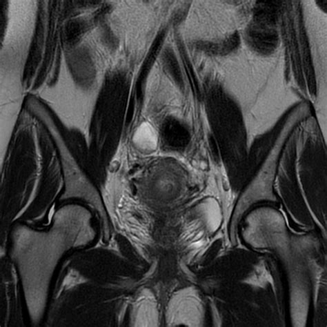 Uterine Arteriovenous Malformation Image