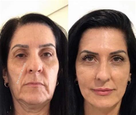 Harmoniza O Facial Harmonia Odonto