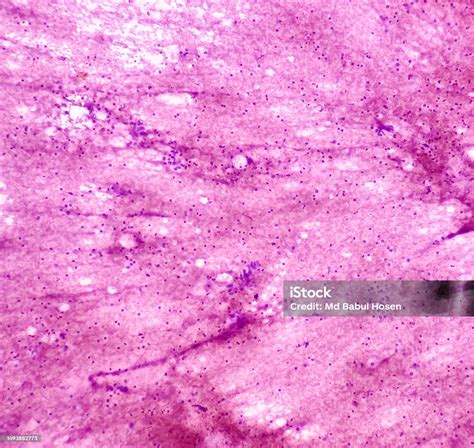 Ct Guided Fna From Lung Lesion Chronic Granulomatous Inflammation With