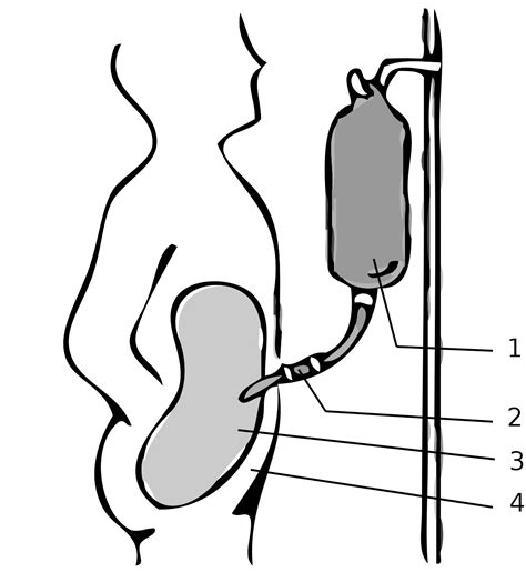 Dialyse Péritonéale Définition Et Explications