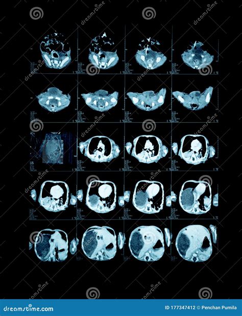 Magnetische Resonantie Afbeelding Mri Van De Hersenen Stock Foto