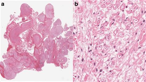 Plexiform Neurofibroma A Low Power Image Of A Plexiform Neurofibroma