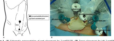 Figure 1 From Two Port Robot Assisted Vs Standard Robot Assisted