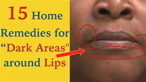 How To Get Rid Of Dark Areas Around Mouth15 Simple Home Remedies Youtube