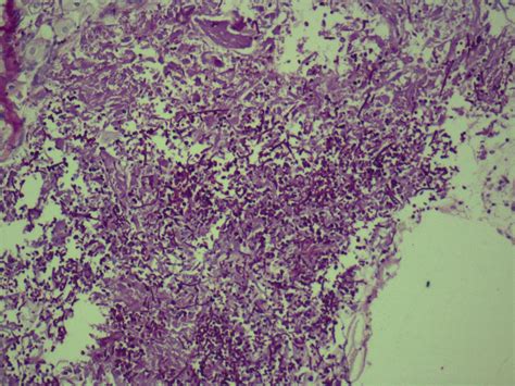 Oral Candidiasis Histology