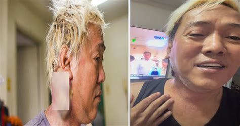 Bukol Ni Ate Gay Sa Leeg Lumiit Na Matapos Ang Na Araw Na Radiation Therapy Balitambayan