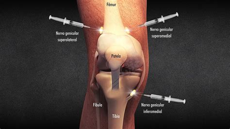 Bloqueio Dos Nervos Do Joelho
