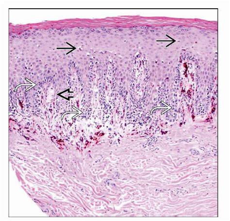 Acral Lentiginous Melanoma Basicmedical Key