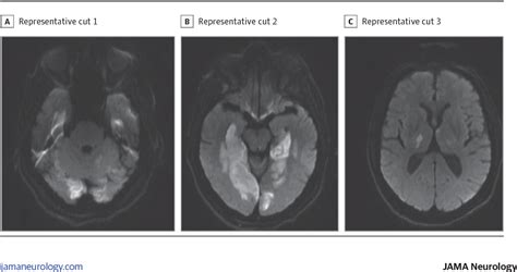 Figure 2 From Top Of The Basilar Syndrome Presenting With Convulsions