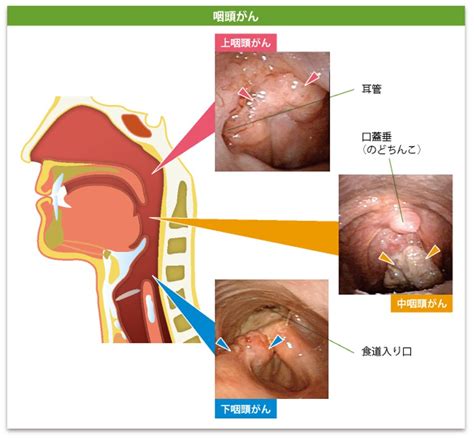 のどの病気 ｜戸塚耳鼻咽喉科クリニック｜戸塚駅徒歩2分の耳鼻科