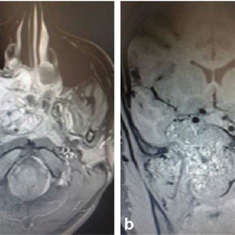 Intraoperative endoscopic view 0º scope infratemporal fossa is