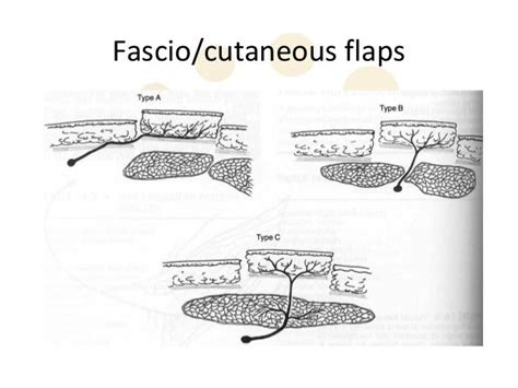 Flap Classification