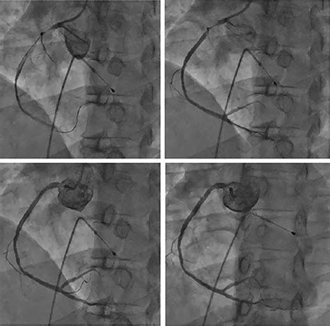 JLE Sang Thrombose Vaisseaux Dune hypoglycémie à un infarctus du