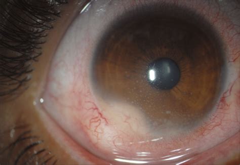 Ocular Leproma In Lepromatous Leprosy Infectious Diseases Jama