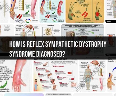 Unraveling The Diagnosis Of Reflex Sympathetic Dystrophy Syndrome