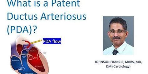 Nursing Management Of Patent Ductus Arteriosus Slideshare