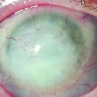 illustrates vascularization and scar formation of the cornea after the... | Download Scientific ...