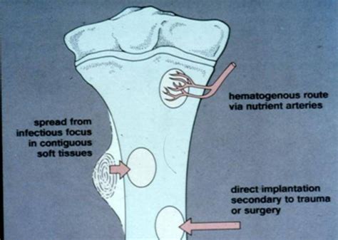 2 Bone Infection Flashcards Quizlet