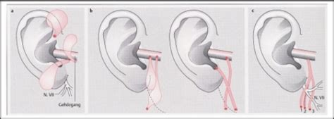 Position Of Ear Pits And Ear Cysts A Type I B Typ Open I