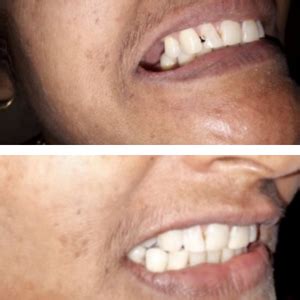 Expert Dental Restoration Filling In Pune Katraj Kondhwa Rasta Peth