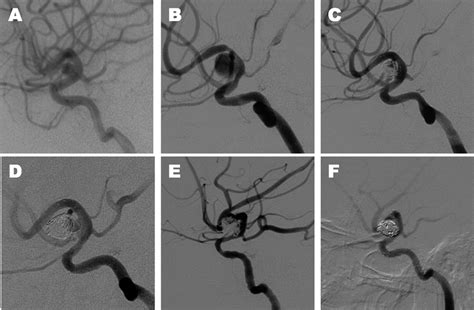 Radiography Of Case A Initial Dsa Showed A Small And Broad Based