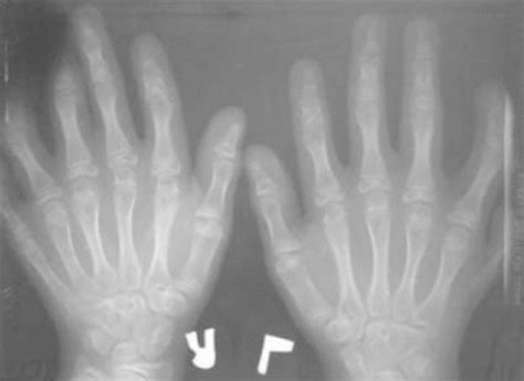 Radiograph Of Hands And Wrist Showed Polydactyly Download Scientific