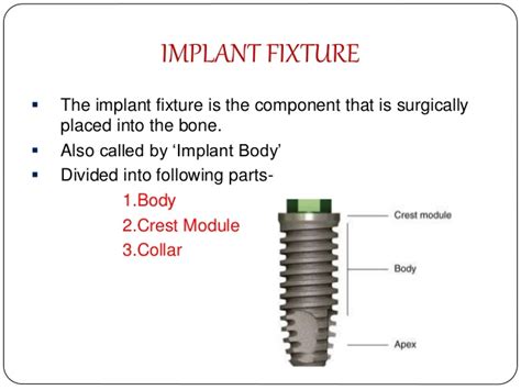 Implant Parts - Dental News Network
