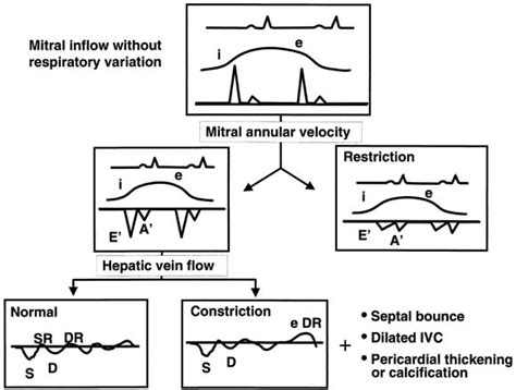 Diagnostic Value Of Mitral Annular Velocity For Constrictive Pericarditis In The Absence Of