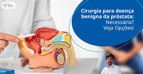 Cirurgia Para Doença Benigna Da Próstata Necessária Veja Opções Dr Cássio Andreoni