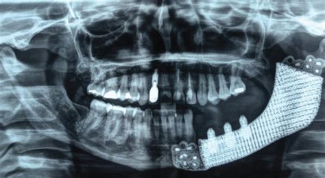 Preoperative A And Postoperative B Radiographs Download Scientific Diagram